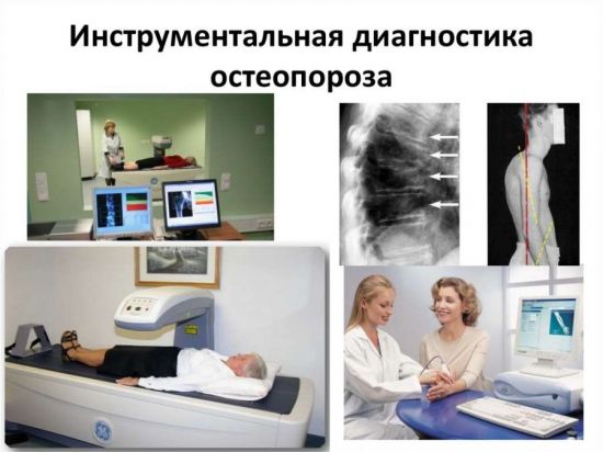 Диагностика остеопороза