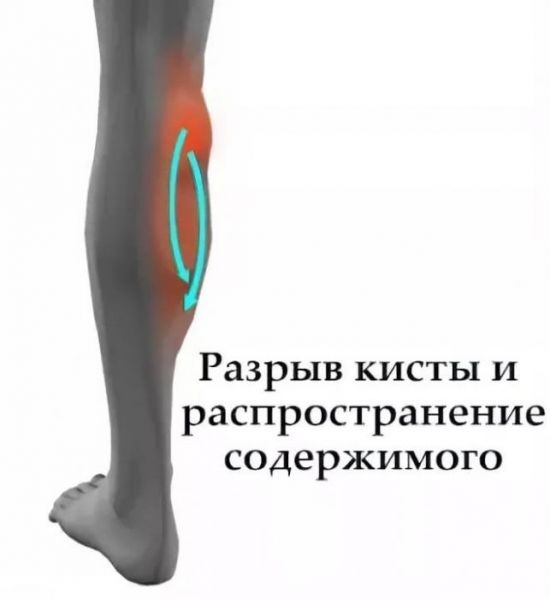 Разрыв кисты под ногой
