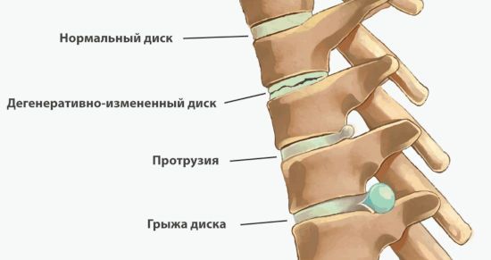 Протрузия и грыжа диска