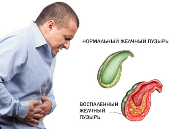 Приступ желчной колики