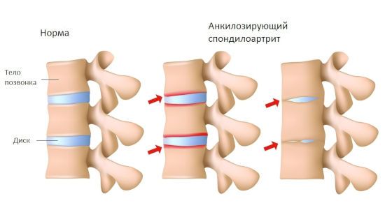 Сращение позвонков