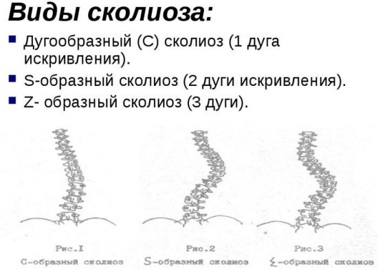 Z-образный сколиоз