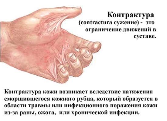 Что такое контрактура