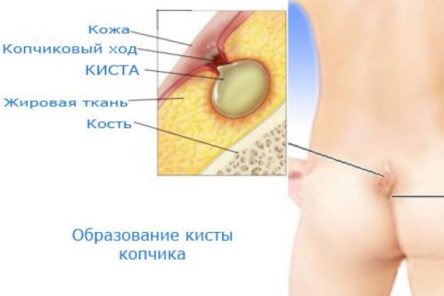 Киста копчика