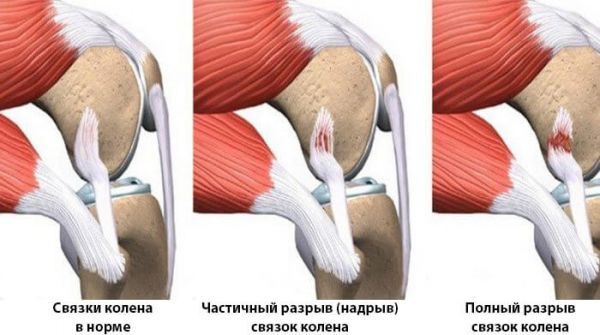 Травма коленного сустава