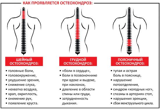 Признаки остеохондроза