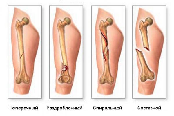 Виды переломов
